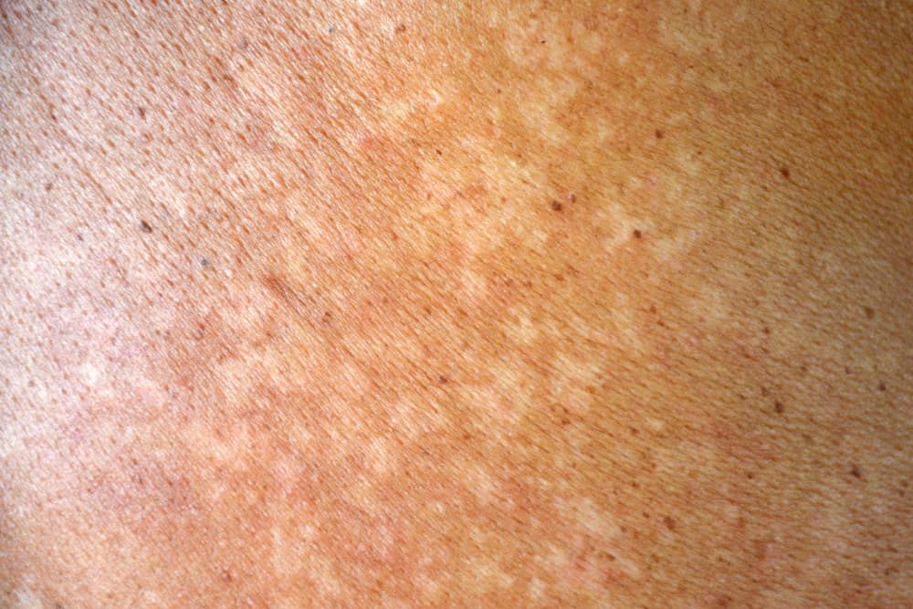 natural-remedies-for-tinea-versicolor