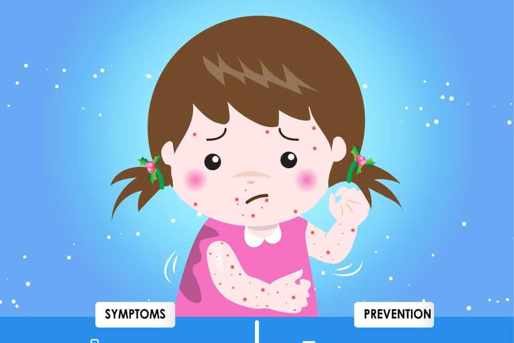 chickenpox-in-babies