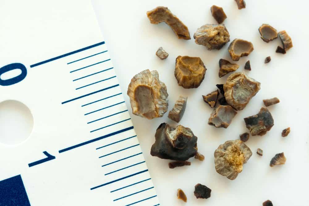 how-to-prevent-kidney-stones