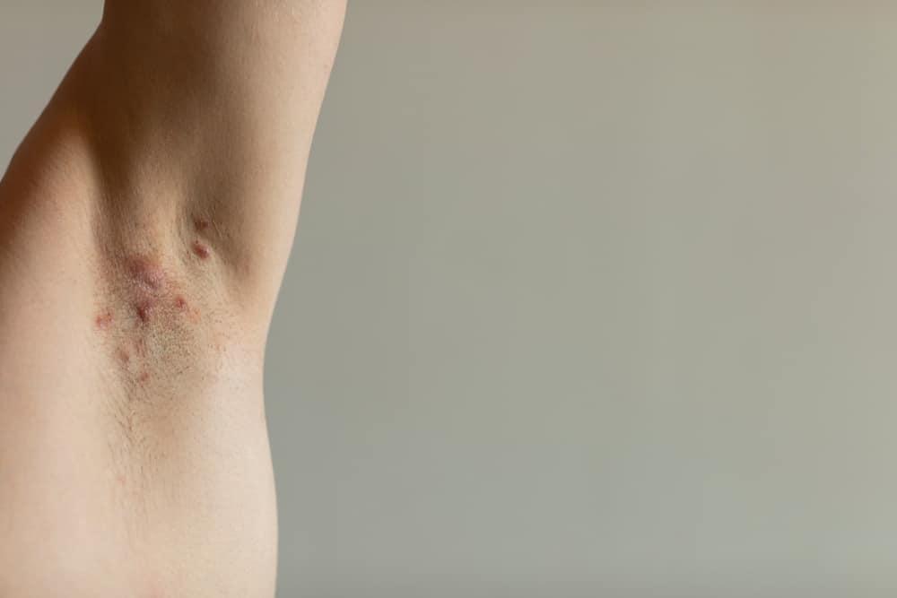 Hidradenitis suppurativa ( HS ) ပြည်တည်နာ တစ်မျိုး