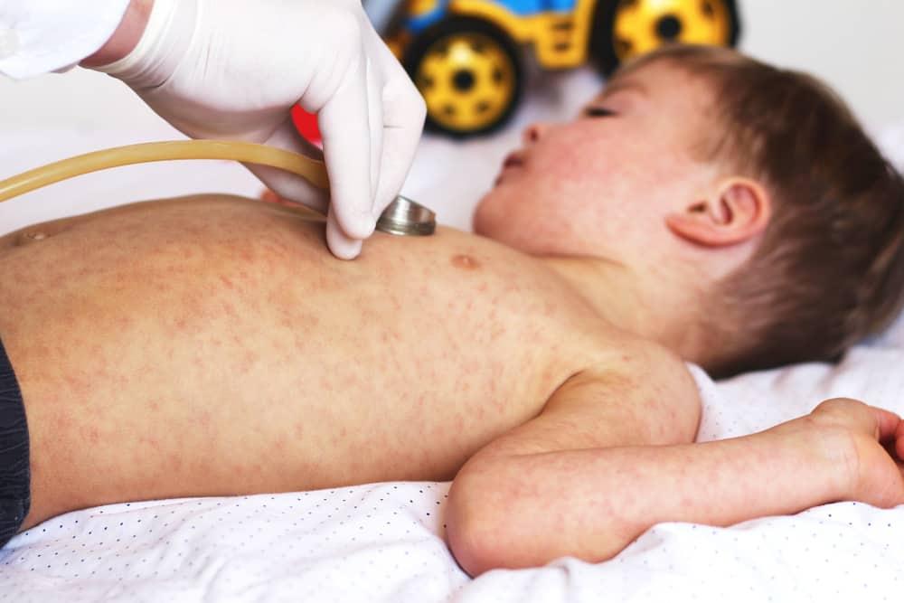  Measles (သို့) ဝက်သက်ရောဂါ အကြောင်း လေ့လာကြမယ်။