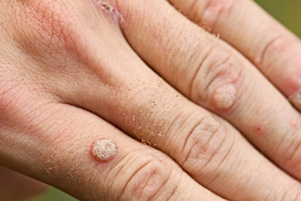 removing-wart