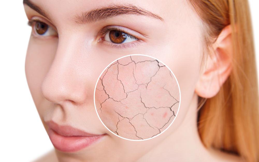 dry-skin
