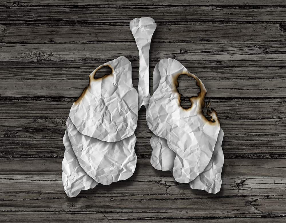 lung-cancer-explained