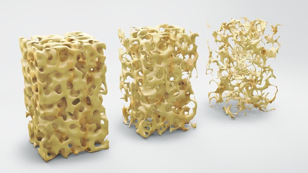 what-foods-should-i-avoid-with-osteoporosis