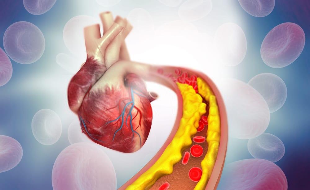 coronary-artery-disease-explained