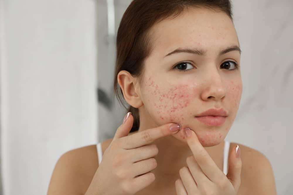 understanding-fungal-acne