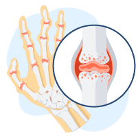 အဆစ်ရောင်ရောဂါများ
