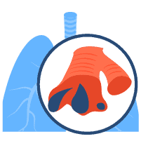 လေပြွန်ရောင်ရောဂါ