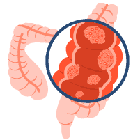 အူမကြီးကင်ဆာ