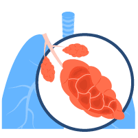 အဆုတ်လေအိတ်ငယ်များ ပျက်စီးသော ရောဂါ