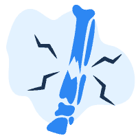 အရိုးကျိုးခြင်း