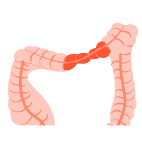 အူမကြီးရောဂါများ (IBS)