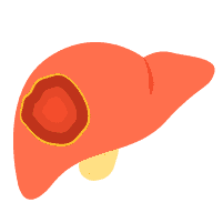 အသည်းကင်ဆာ