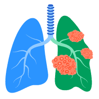 အဆုတ်ကင်ဆာ