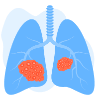အဆုတ်တွင်း granuloma အကျိတ်ဖြစ်ခြင်း