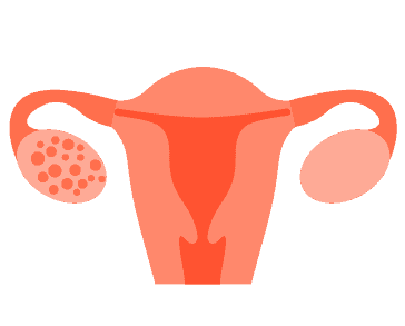 သားဥအိမ်အရည်အိတ်တည်ခြင်း ရောဂါစု