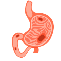 အစာအိမ်နှင့် အူလမ်းကြောင်းအနာ