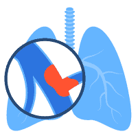 အဆုတ်သွေးကြော သွေးခဲပိတ်ရောဂါ