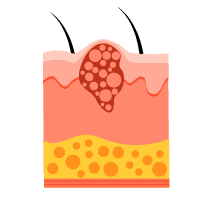 အရေပြားကင်ဆာ