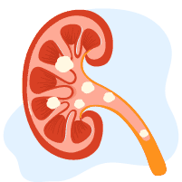 ဆီးလမ်းကြောင်း ကျောက်တည်ခြင်း