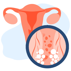 သားအိမ်အလုံးတည်ခြင်းရောဂါများ