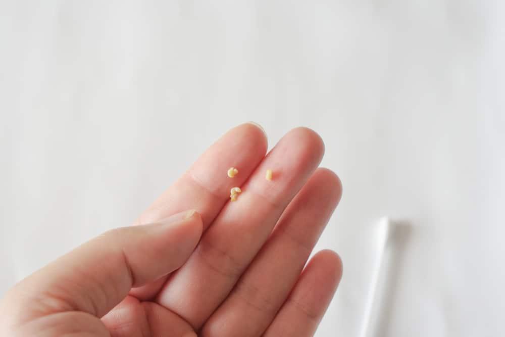 Tonsil Stones ဆိုတာ ဘာလဲ.......