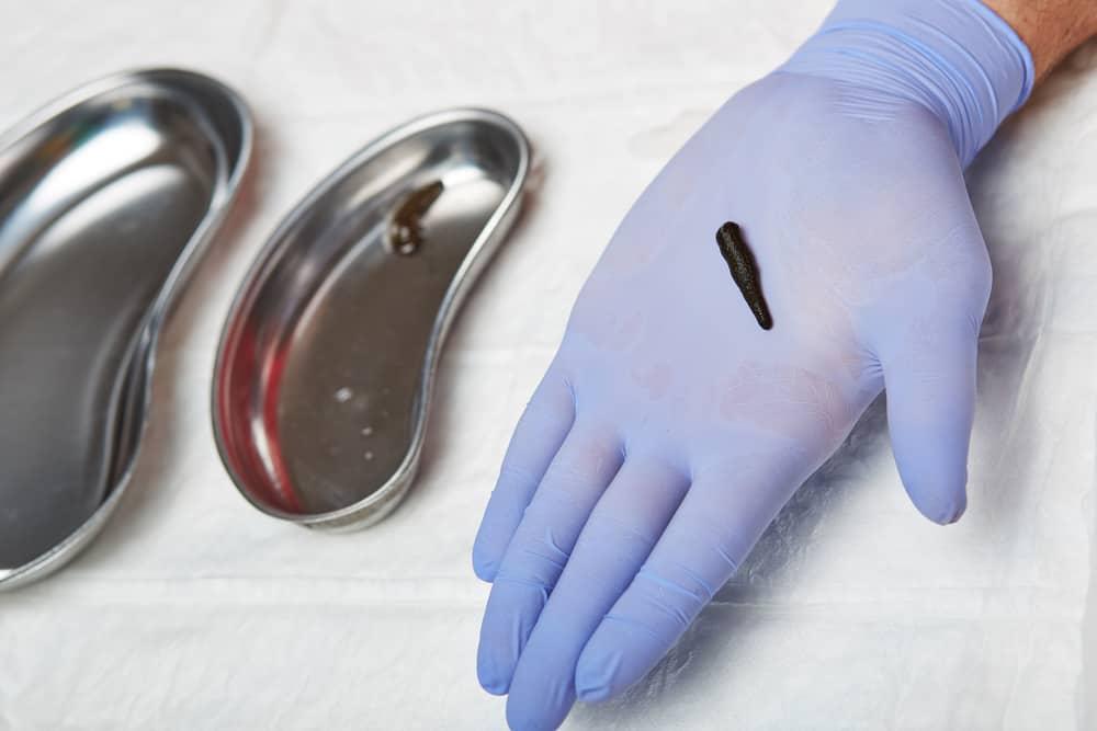 natural-remedy-for-leech-bite