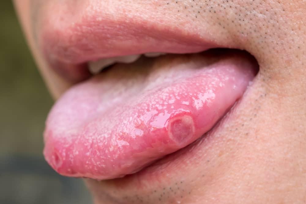 home-remedies-for-sore-on-tongue