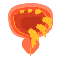 ဆီးအိမ်ကင်ဆာ