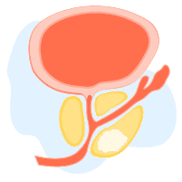 ဆီးကျိတ်ရောဂါ ဖြစ်နိုင်ခြေ စစ်ဆေးခြင်း