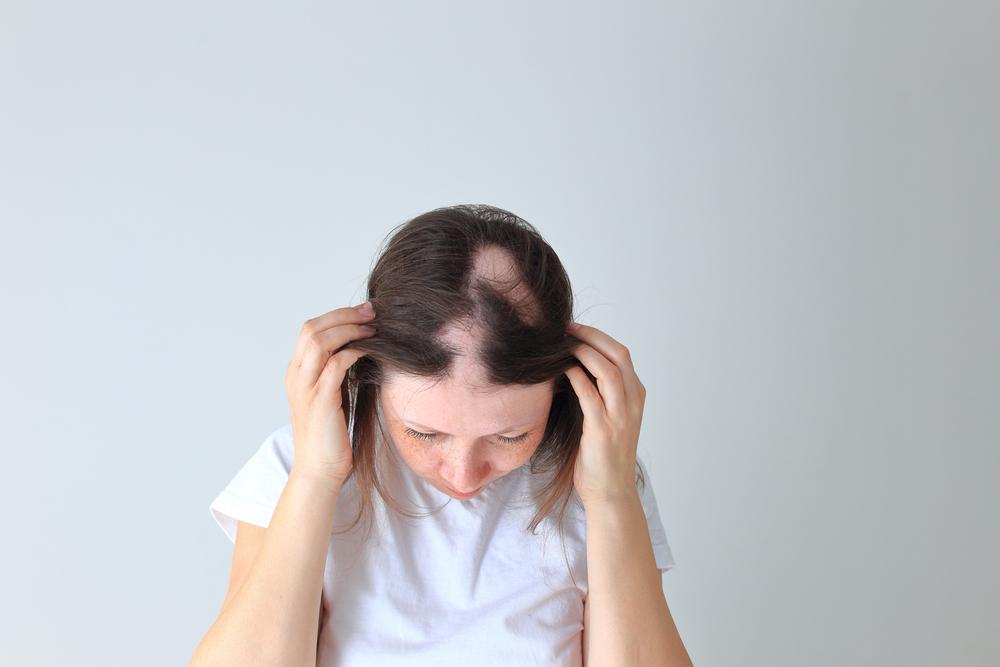 ဆံပင်တွေ အကွက်လိုက် ကျွတ်စေတဲ့ Alopecia areata