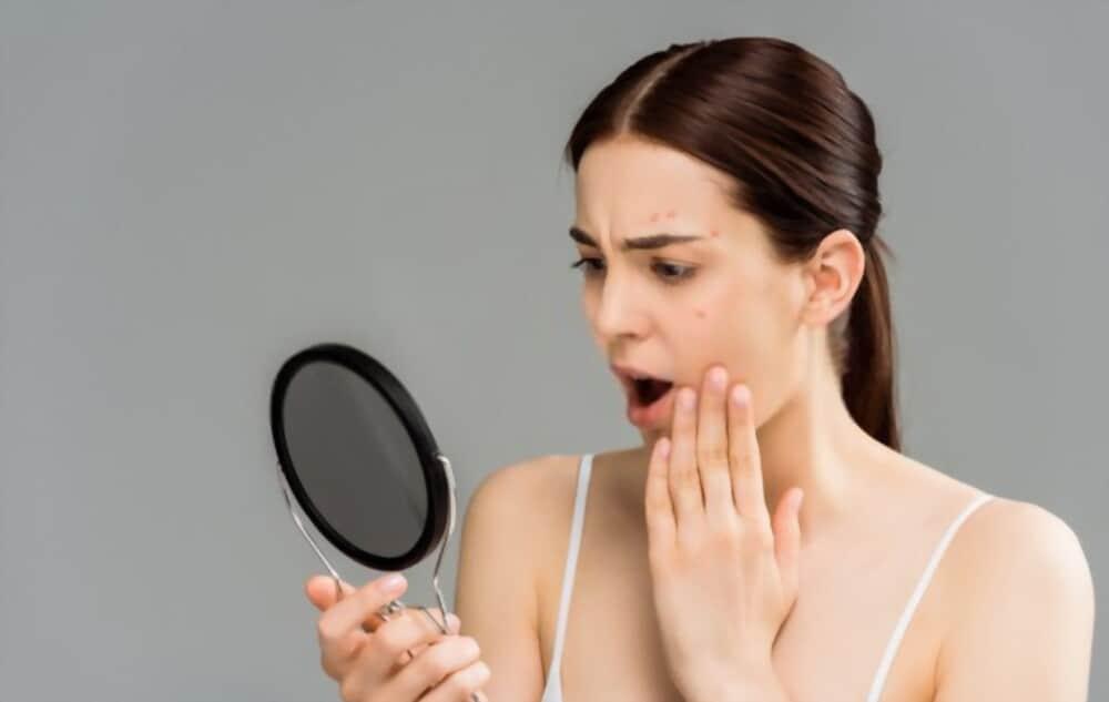 home-remedies-for-inflamed-acne