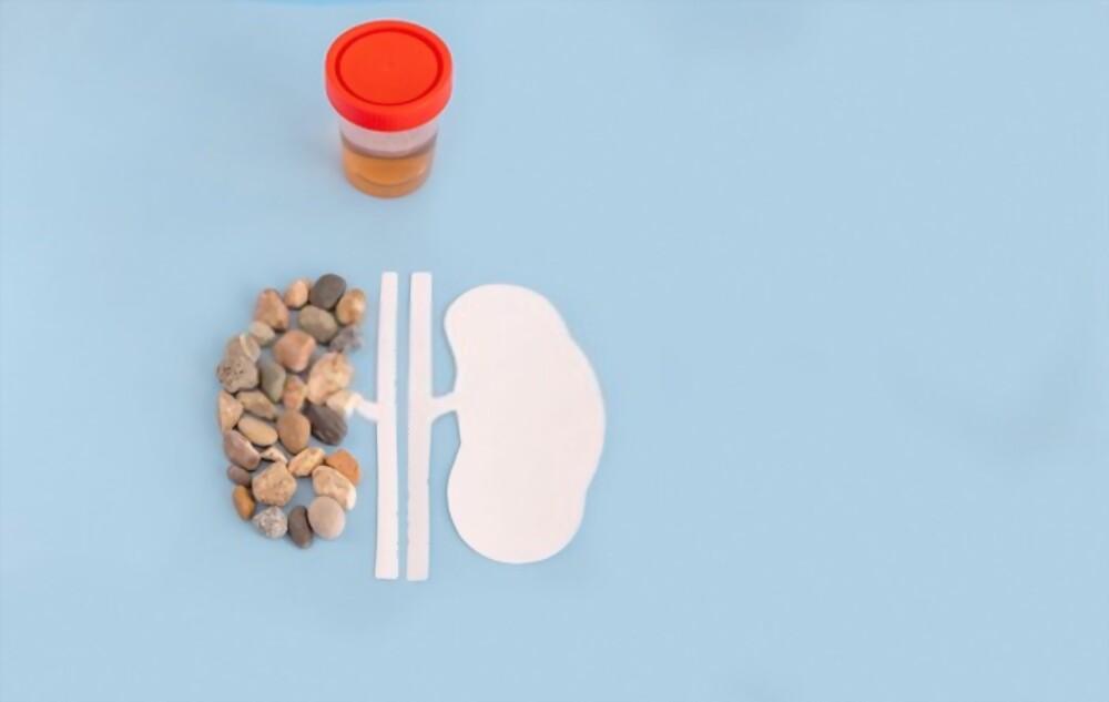 kidney-stones-diagnosis-and-treatment