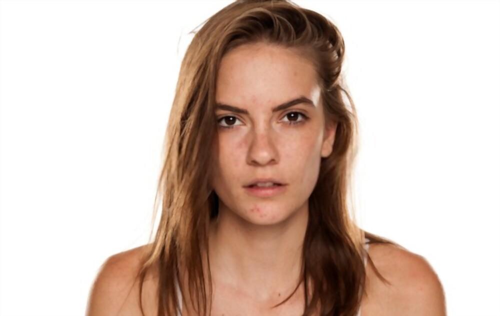 melasma-treatment-at-home