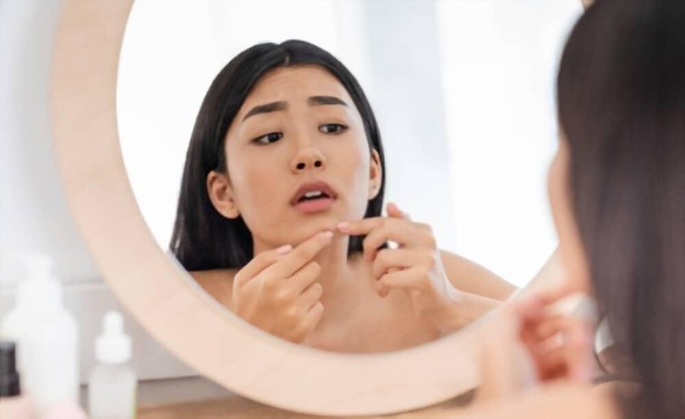 salty-foods-can-cause-pimples